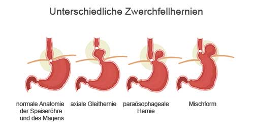 Hernienformen-230367456deutschweb