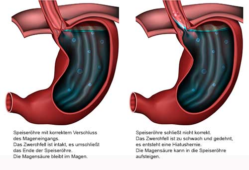 Sodbrennen_145264376deutschweb